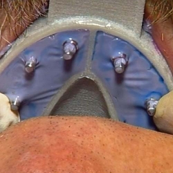 Hager MiraTray Implant Upper Small
